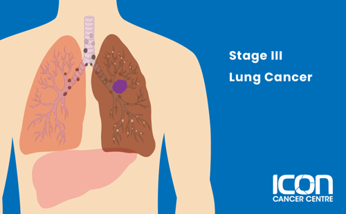Stage III lung cancer illustration