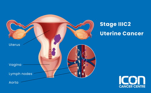 Stage IIIC2 uterine cancer