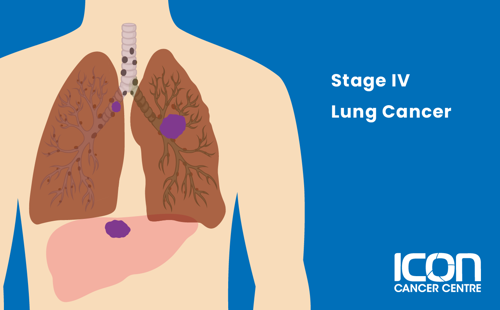 Stage IV lung cancer illustration